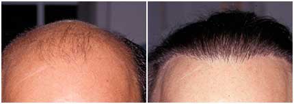 Male Hair Transplant, Philadelphia | Hair Restoration for Men, PA