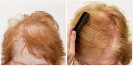 Before and After Treatment Photos - Female Pattern Hair Restoration - 72 year old female, front - top view