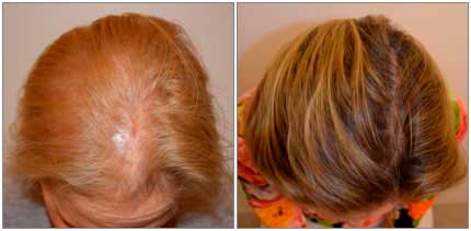 Before and After Treatment Photos - female patient (top view)