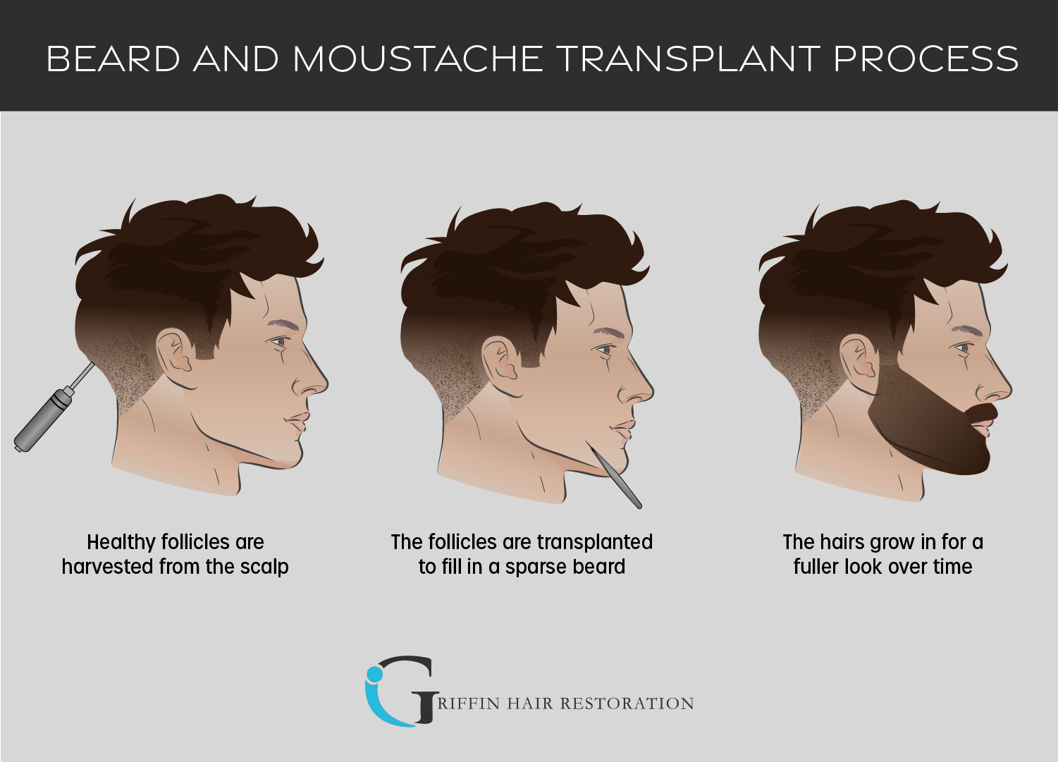 Beard and Moustache Transplant Process