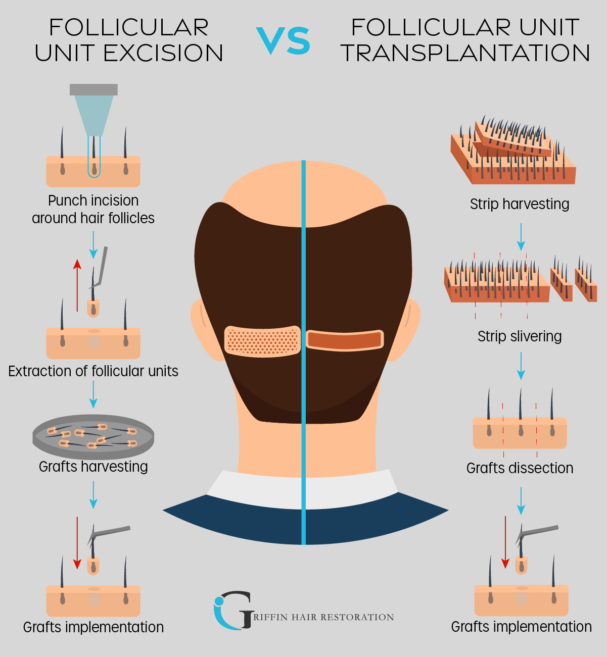 See FUE vs FUT for male hair transplant at the Philadelphia area’s Griffin Hair Restoration Center.